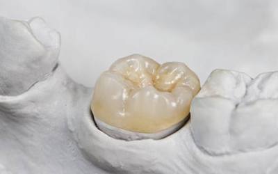 Model smile with dental crown restoration