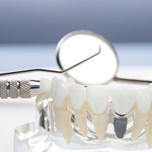 dental implant and tooth model
