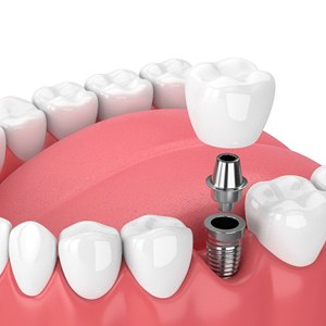 dental implant, abutment, and crown