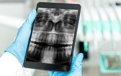 Panoramic dental x-rays