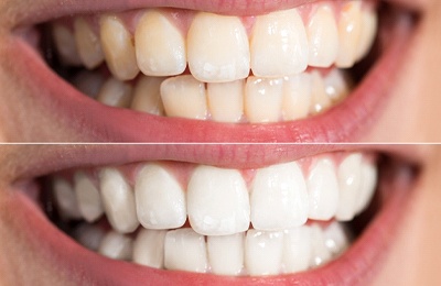 before and after teeth whitening