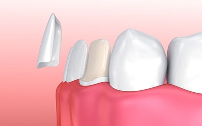 Porcelain veneer being put on a lower tooth