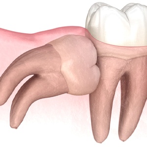 X-ray of wisdom tooth